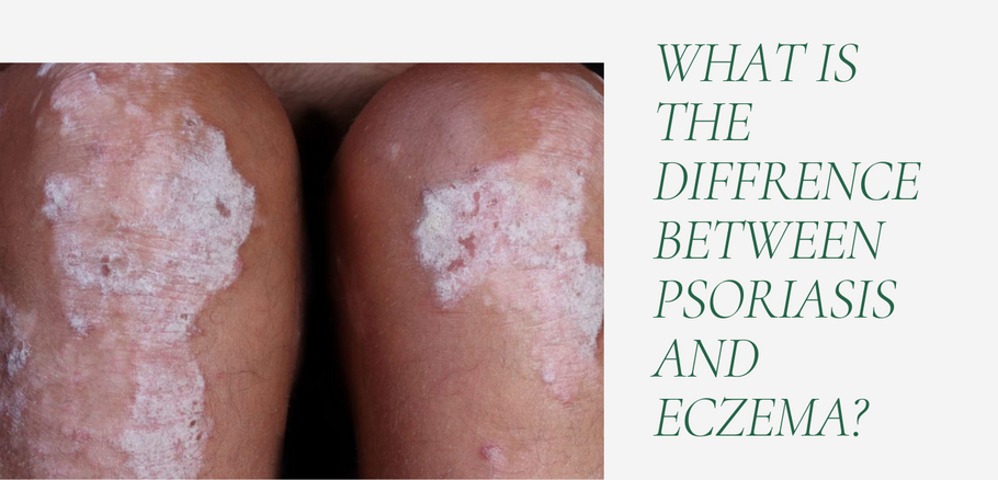 Whats The Difference Between Psoriasis And Eczema?