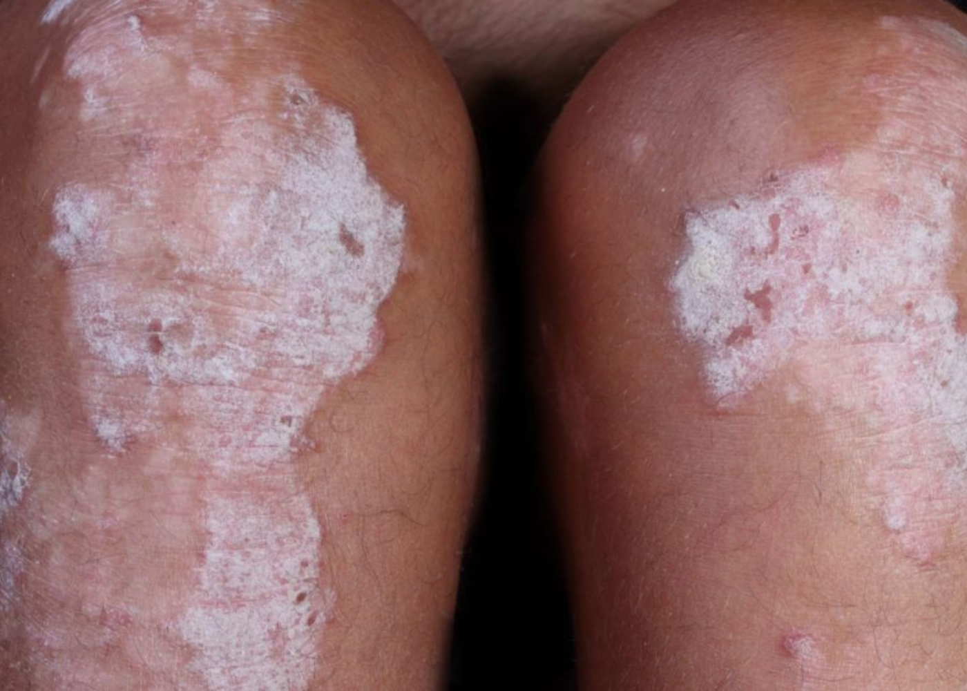 Whats The Difference Between Psoriasis And Eczema?