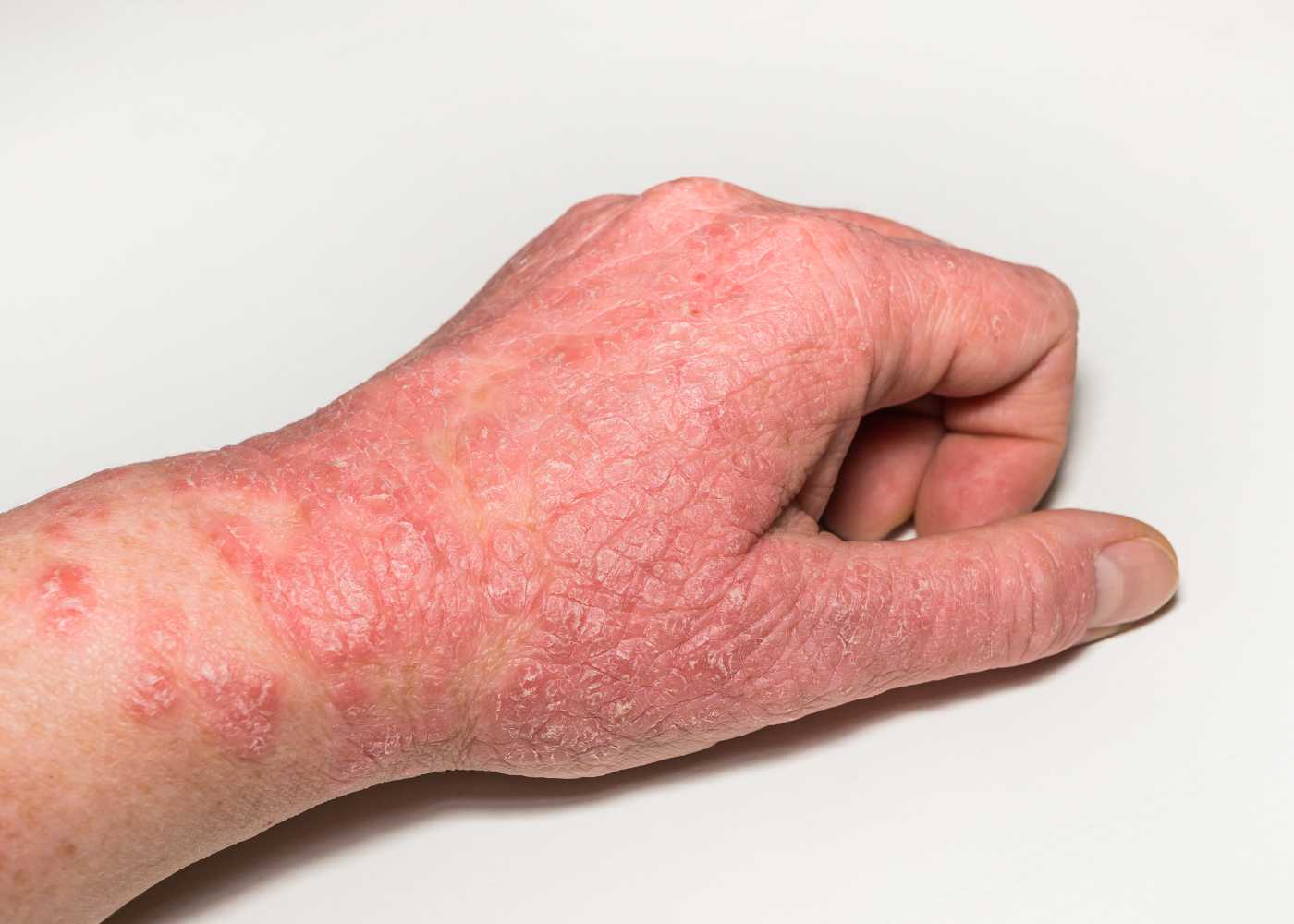 5 Signs You Have Topical Steroid Withdrawal (TSW): Understanding the Journey to Healing